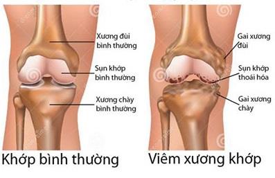 Nhiễm khuẩn xương và khớp do nấm